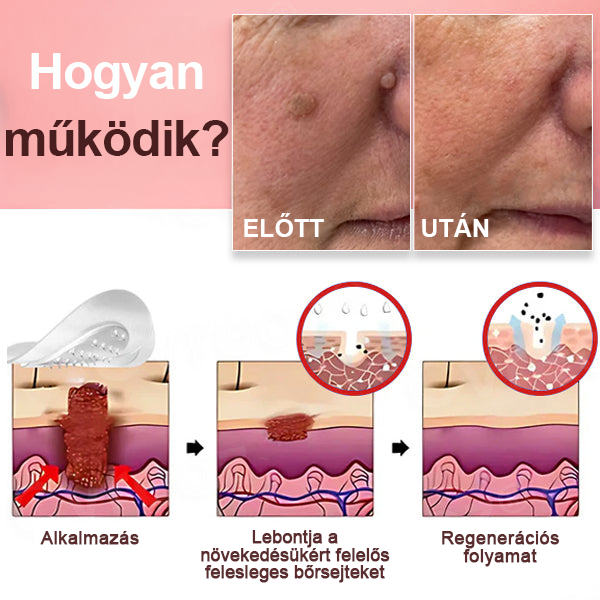 KUBOZN® Nano-mikrotűs bőrcímke-eltávolító tapaszok✨